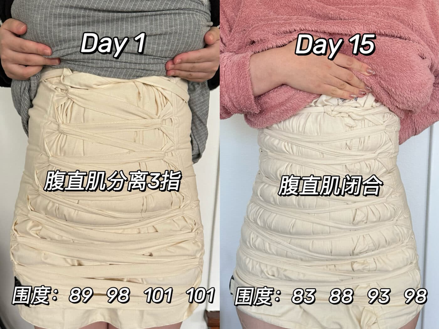 同一位妈妈扎肚第 1 天与第 15 天的对比