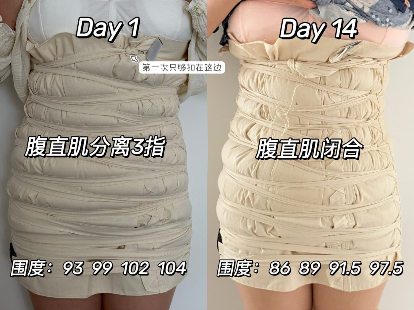 同一位妈妈扎肚第 1 天与第 14 天的对比