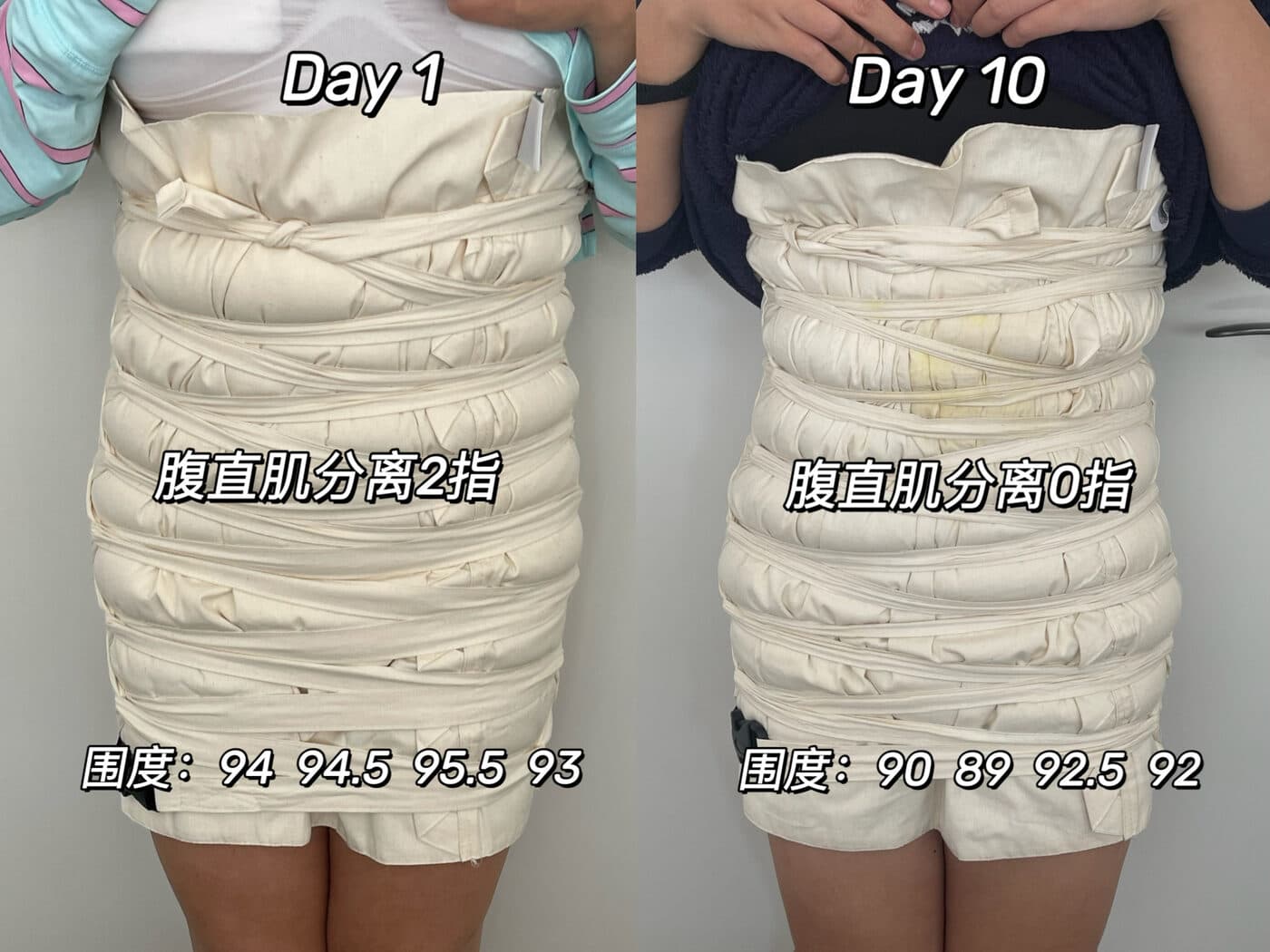 同一位妈妈扎肚第 1 天与第 10 天的对比